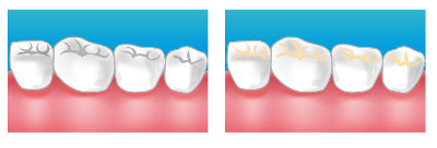 Caries Saint-Just-Saint-Rambert
