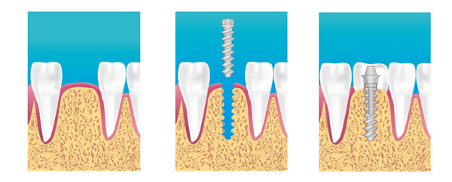 implant dentaire à Saint-Just-Saint-Rambert 